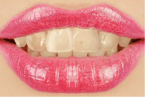 teeth whitening in London