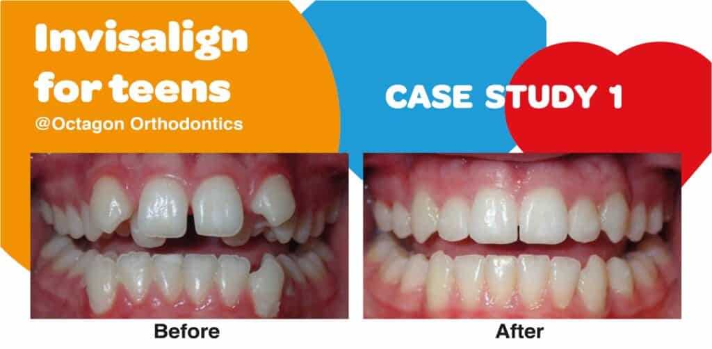 INVISALIGN TEEN CASE STUDY 1